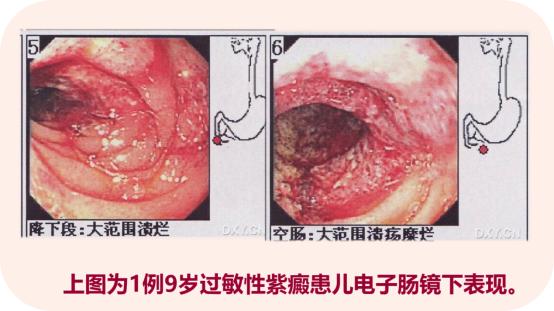 小儿过敏性紫癜是什么样子（小儿过敏性紫癜）(3)