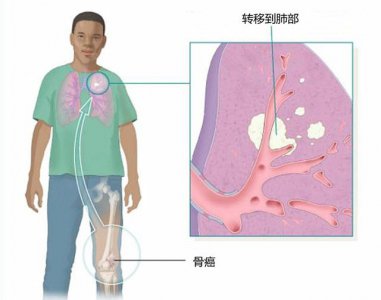 ​骨癌的前兆是什么样子的（早期有这4点征兆）