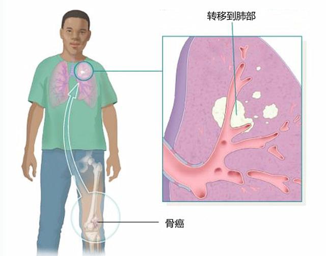 骨癌的前兆是什么样子的（早期有这4点征兆）(1)