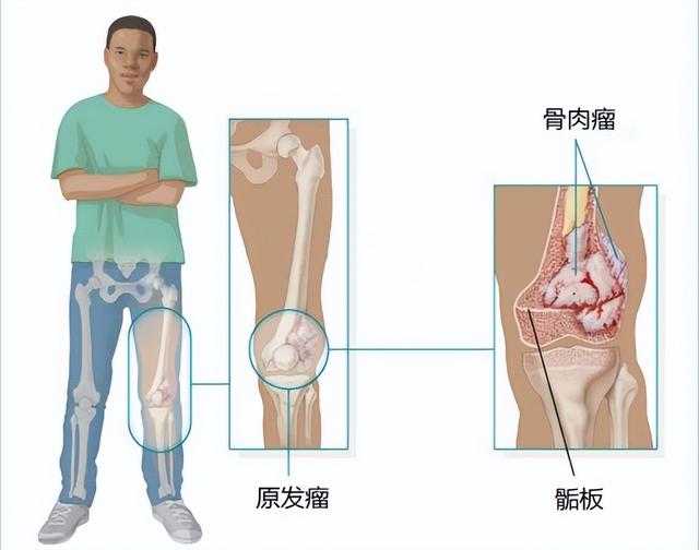 骨癌的前兆是什么样子的（早期有这4点征兆）(3)