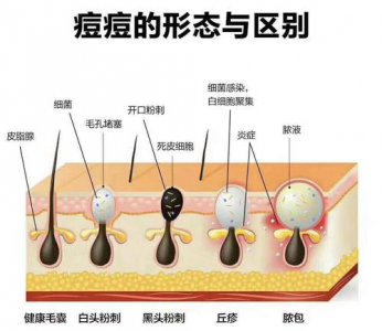 ​痘痘里面是什么（痘痘的形成）