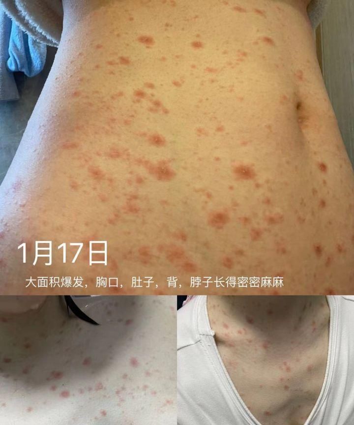 什么是糠疹和湿疹有什么区别呢