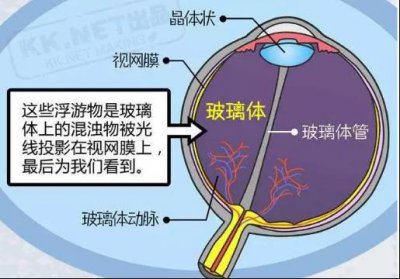 ​玻璃体混浊的治疗 玻璃体混浊如何治疗