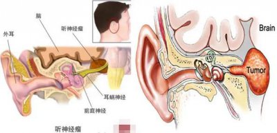 ​（耳内疼痛，伴听力下降、眩晕、什么原因？怎么应对呢？）