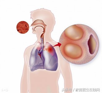 ​结核病菌 4个征兆一出现，暗示你已感染肺结核