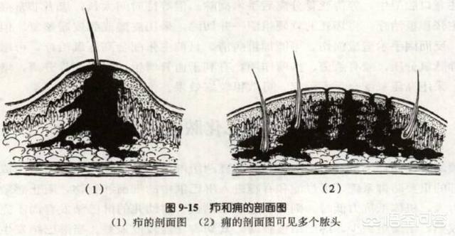 为什么古人只要背上长疮就会死呢?