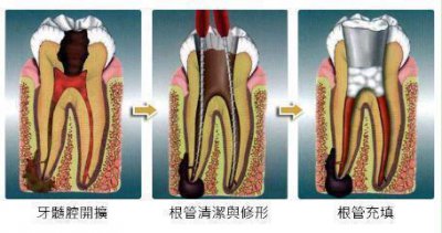 ​牙齿做根管治疗的步骤和费用